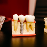 implantas