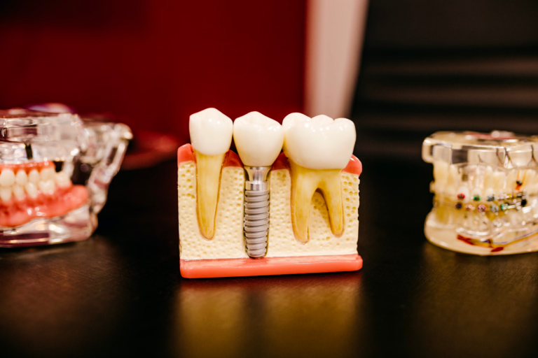 implantas